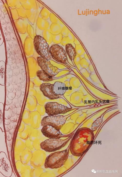 乳腺纤维腺瘤的相关图片