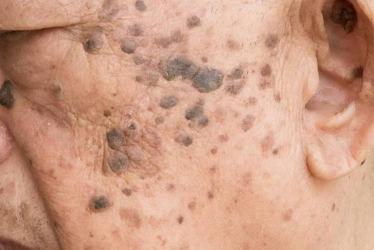红霉素祛老年斑的相关图片